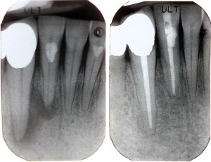 Endodontie Zahnwurzelkanalbehanlung - Zahnarzt Dorsten