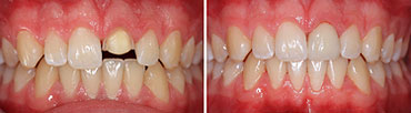 Frontzahnkrone, abgebrochener Zahn - Zahnarzt Dorsten